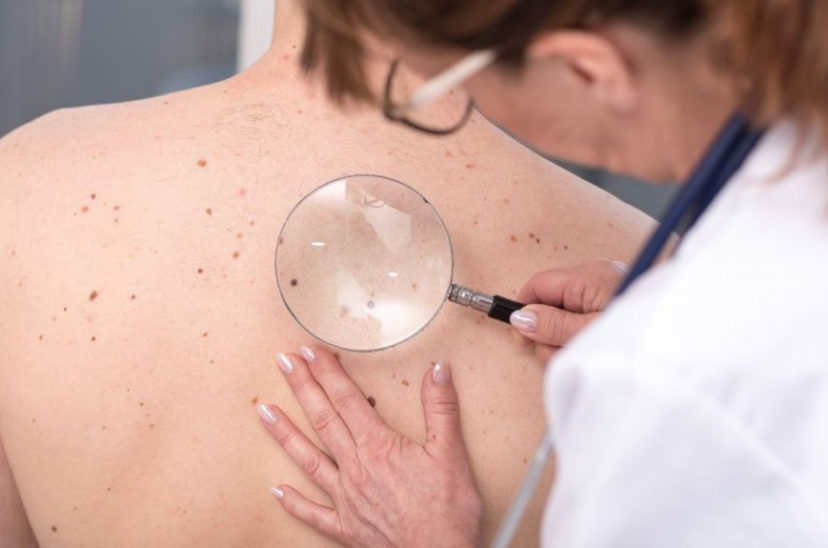 Vacuna cáncer de piel melanoma