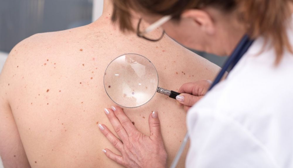 Vacuna cáncer de piel melanoma